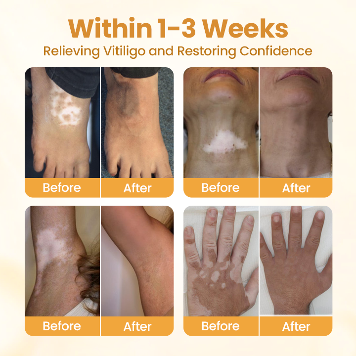 ODEIUN™ VitiClear Pro Bee Venom Cream – Targeted Care for Even-Toned Skin