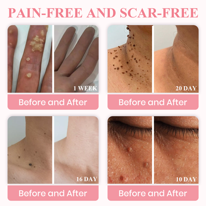 Negusy™ Dual Acid Wart & Mole Removal Serum