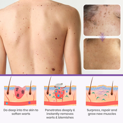 Seurico™ New NatureVanish Mole & Dark Spot Removal Bio-Gel