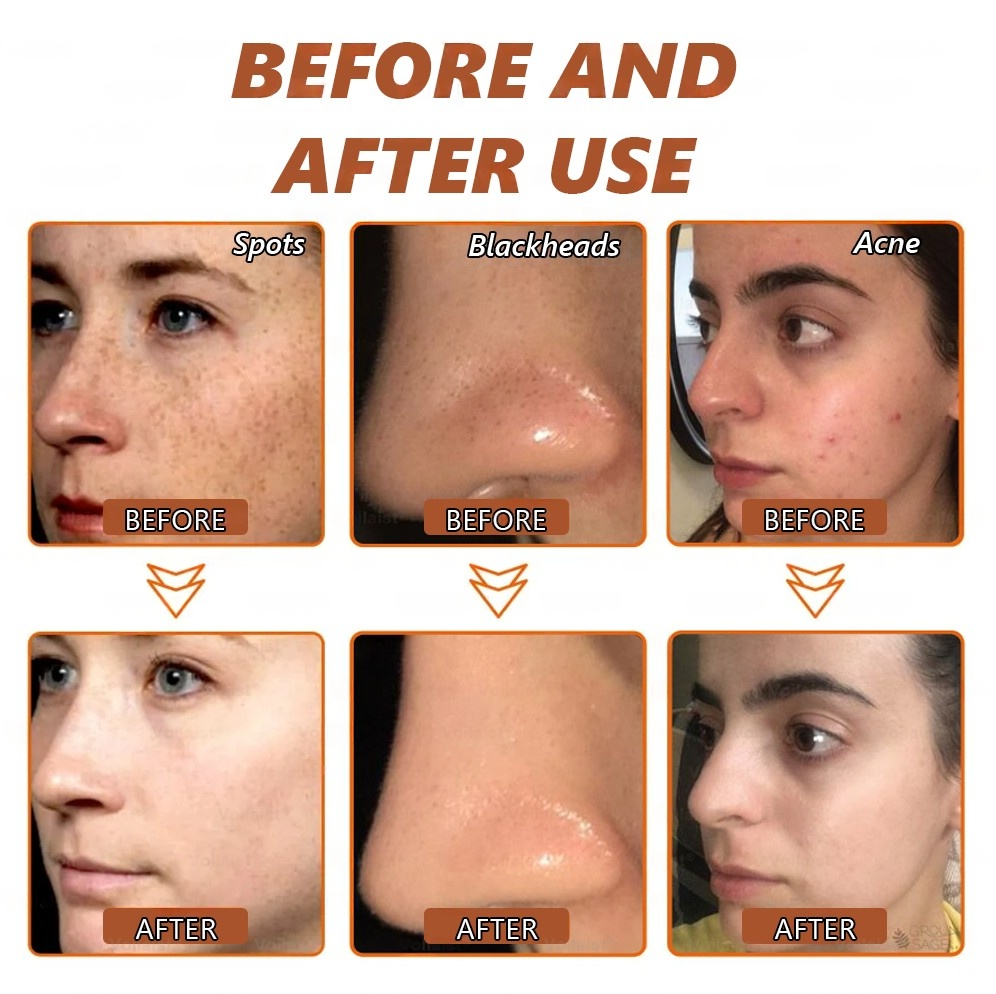 🏵️ Zakdavi™ Radiant Whitening & Spot Eraser Mask✨| For Face and Body - Formulated with natural ingredients to permanently eliminate age spots, freckles, sun spots, and liver spots.