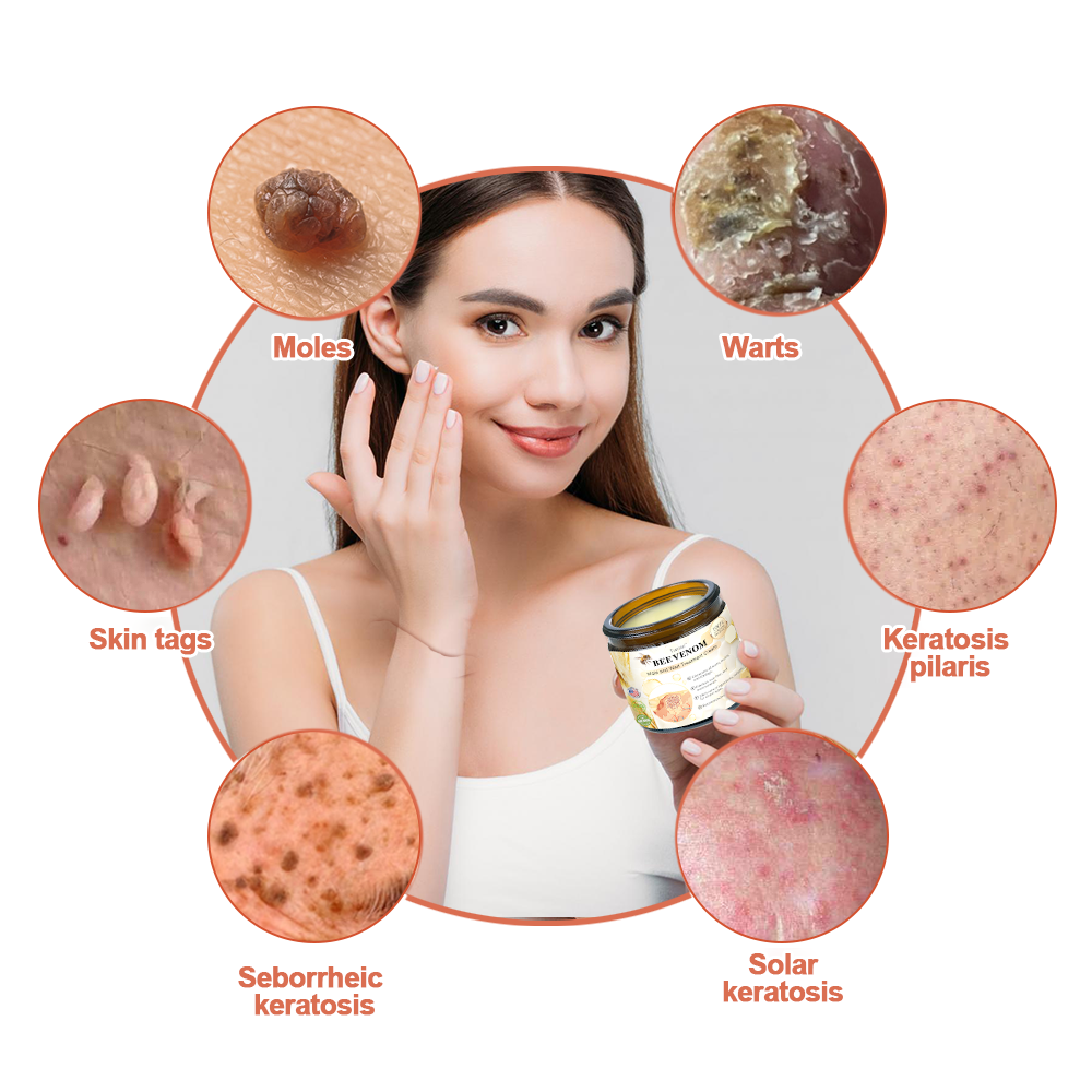 Honeybee Venom Mole and Wart Cream