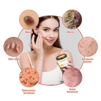 Honeybee Venom Mole and Wart Cream