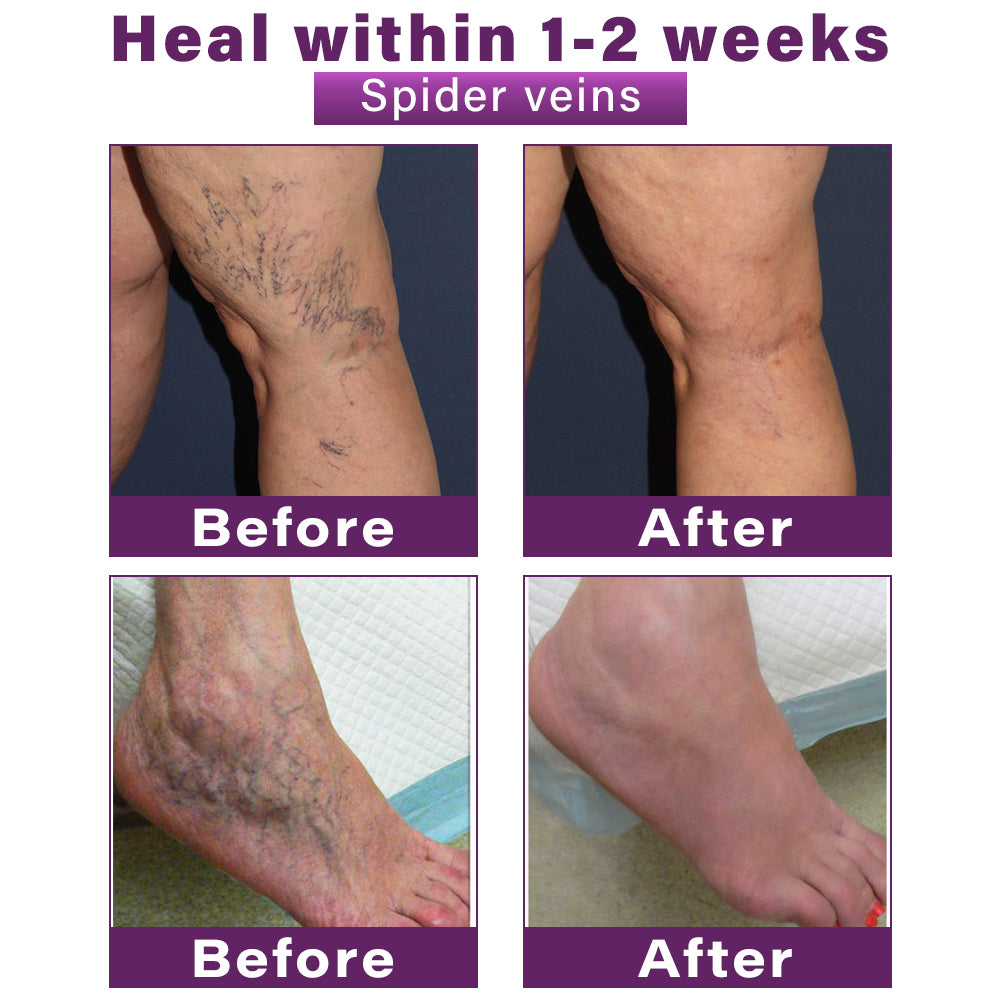 Seurico™ Polidocanol Nano Varicose Vein Relief Patch 👩🏼‍⚕️ Clinically Recommended by NICE (National Institute for Health and Care Excellence)