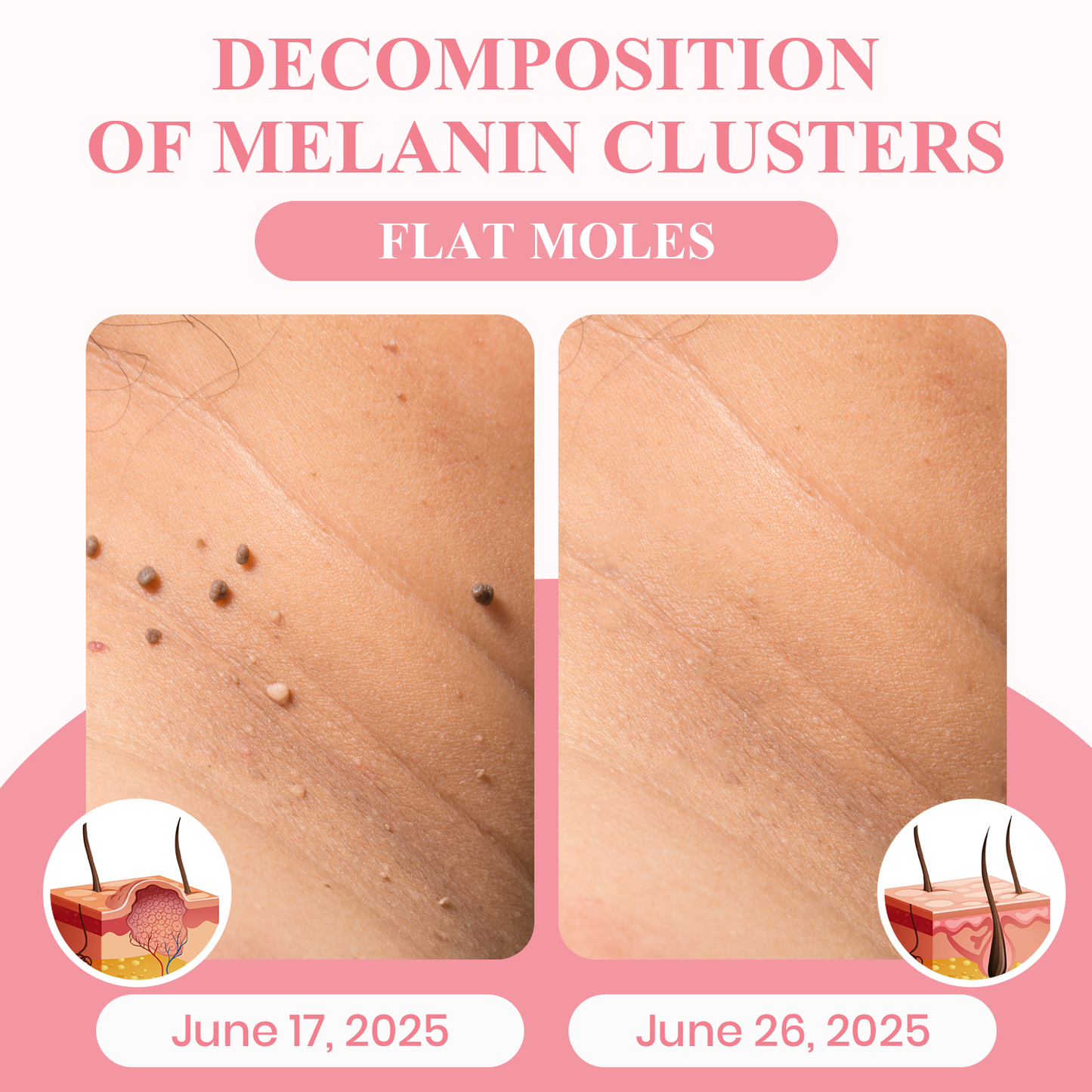 Negusy™ Dual Acid Wart & Mole Removal Serum