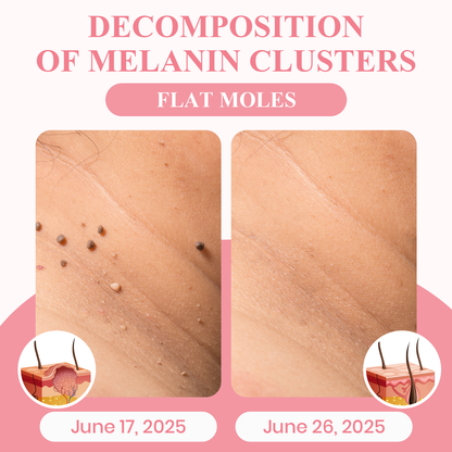 Negusy™ Dual Acid Wart & Mole Removal Serum