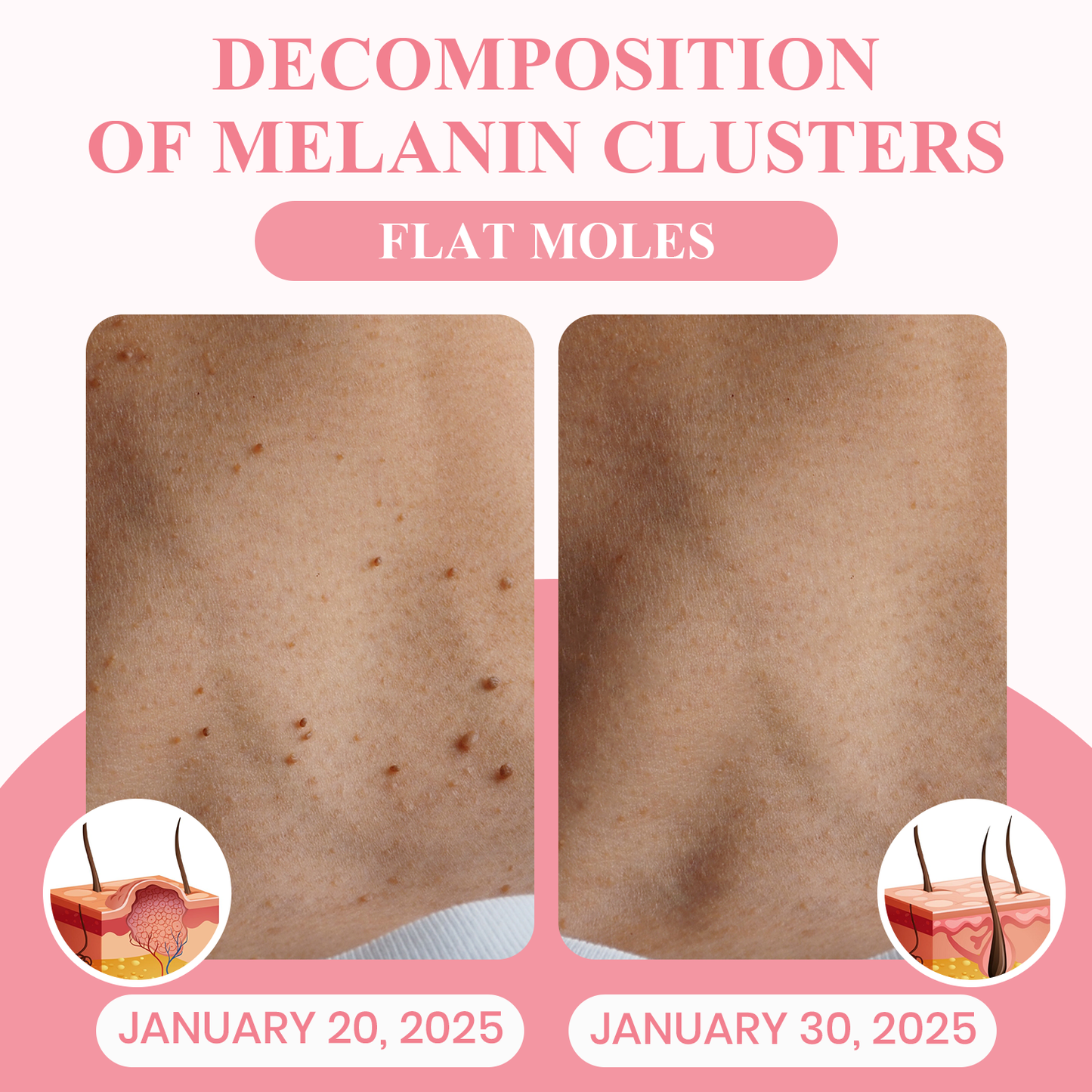 Negusy™ Dual Acid Wart & Mole Removal Serum