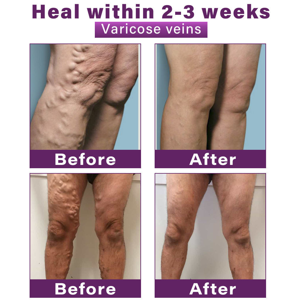 Seurico™ Polidocanol Nano Varicose Vein Relief Patch 👩🏼‍⚕️ Clinically Recommended by NICE (National Institute for Health and Care Excellence)