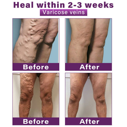 Seurico™ Polidocanol Nano Varicose Vein Relief Patch 👩🏼‍⚕️ Clinically Recommended by NICE (National Institute for Health and Care Excellence)