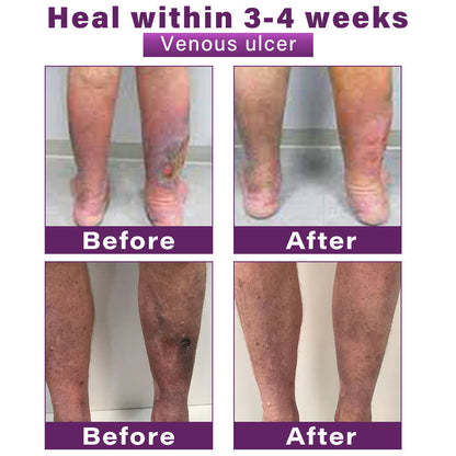 Seurico™ Polidocanol Nano Varicose Vein Relief Patch 👩🏼‍⚕️ Clinically Recommended by NICE (National Institute for Health and Care Excellence)