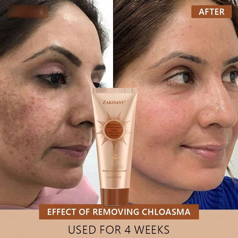 🏵️ Zakdavi™ Radiant Whitening & Spot Eraser Mask✨| For Face and Body - Formulated with natural ingredients to permanently eliminate age spots, freckles, sun spots, and liver spots.