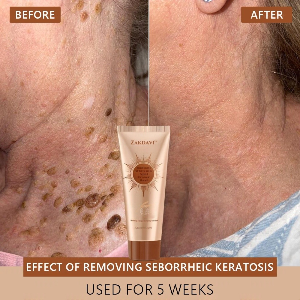 🏵️ Zakdavi™ Radiant Whitening & Spot Eraser Mask✨| For Face and Body - Formulated with natural ingredients to permanently eliminate age spots, freckles, sun spots, and liver spots.