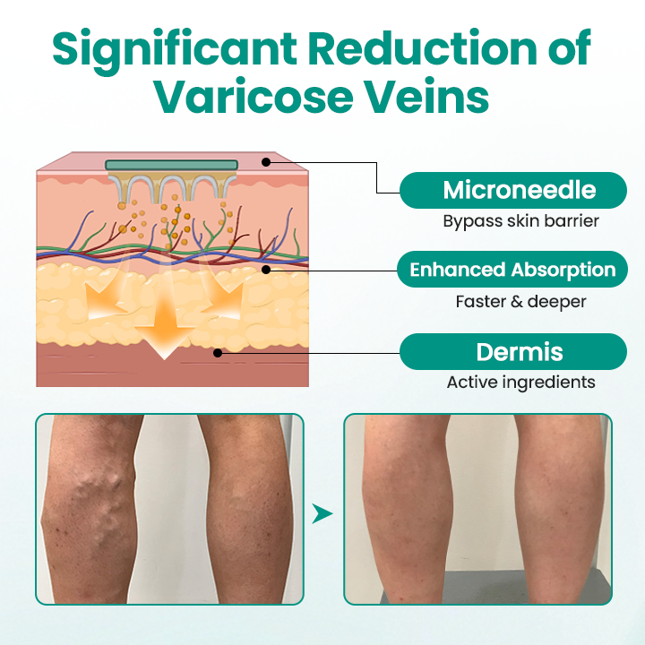 🩺 RELIEVEIN® Advanced Varicose Veins Patch: Clinical-Strength Vein Repair & Swelling Relief  🦵