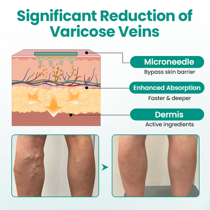 🩺 RELIEVEIN® Advanced Varicose Veins Patch: Clinical-Strength Vein Repair & Swelling Relief  🦵