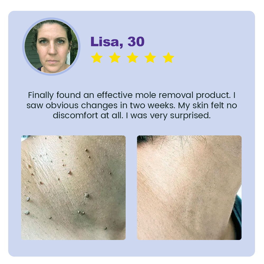 Seurico™ New NatureVanish Mole & Dark Spot Removal Bio-Gel