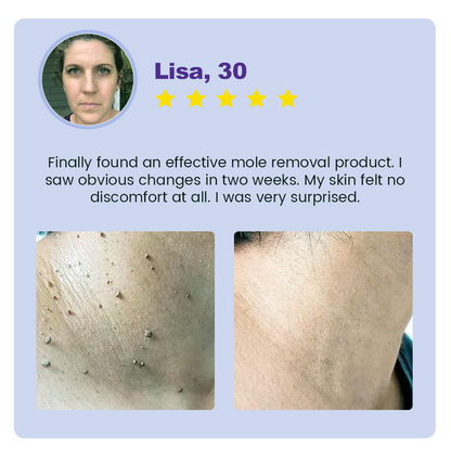 Seurico™ New NatureVanish Mole & Dark Spot Removal Bio-Gel