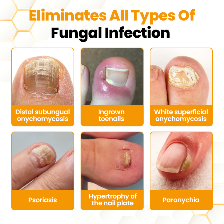 Seurico™ BeeVenom Anti-Fungal Nail Renewal Oil