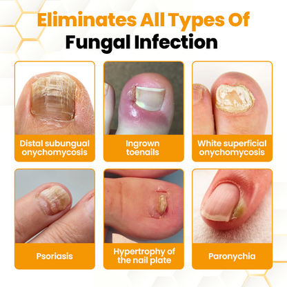 Seurico™ BeeVenom Anti-Fungal Nail Renewal Oil