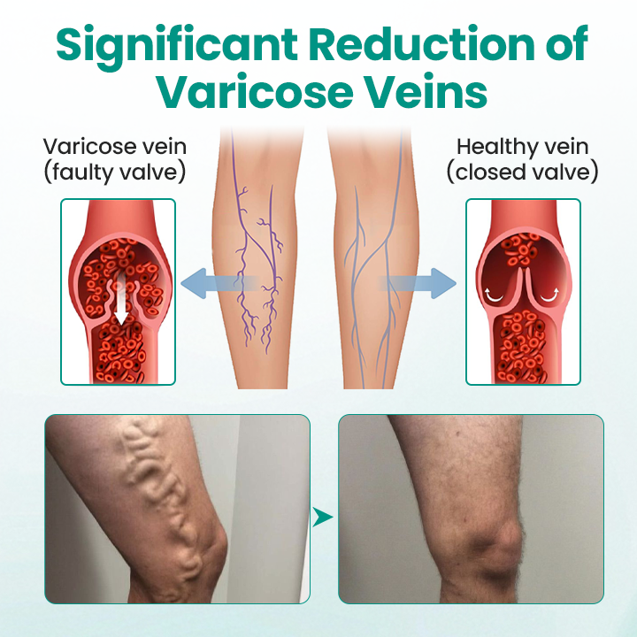 🩺 RELIEVEIN® Advanced Varicose Veins Patch: Clinical-Strength Vein Repair & Swelling Relief  🦵