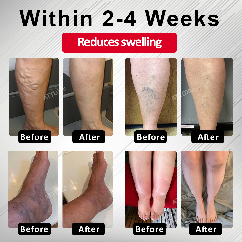 ODEIUN™ Advanced CVI Edema Therapy Cream