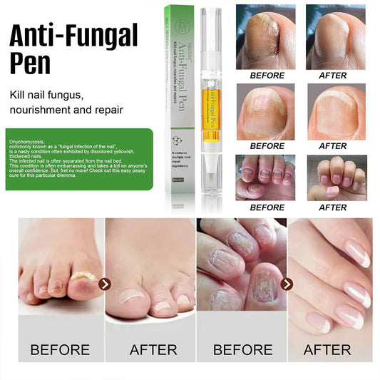 Negusy™ Antifungal Pen – Clinically Proven Natural Solution for Stubborn Toenail Fungus