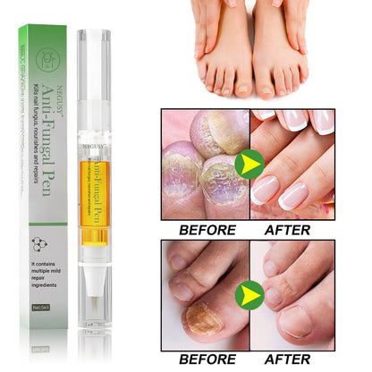 Negusy™ Antifungal Pen – Clinically Proven Natural Solution for Stubborn Toenail Fungus