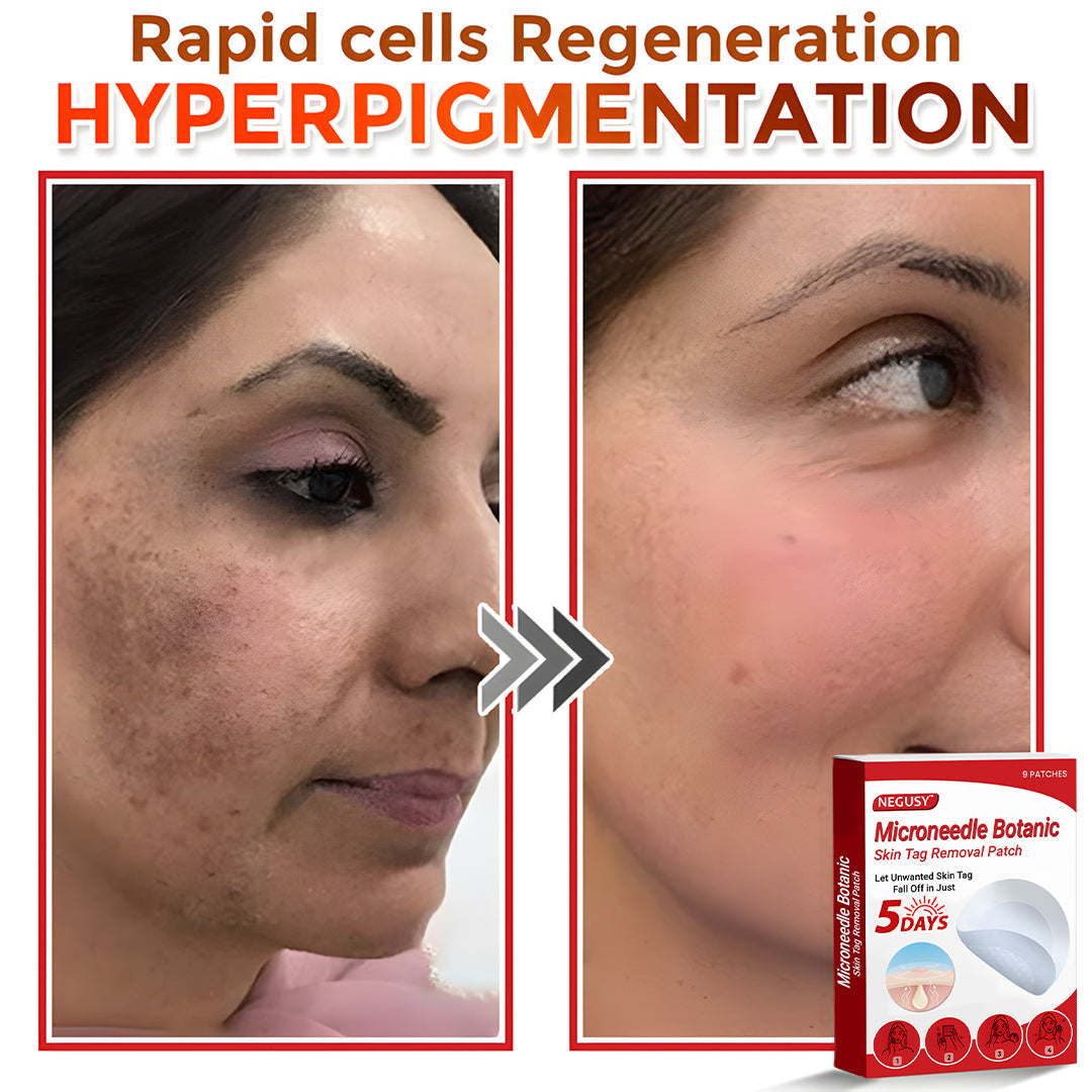 🔥Limited Time Discount🌿 Negusy™ MicroNeedle Skin Tag Remover Patch – Plant-Based & Painless