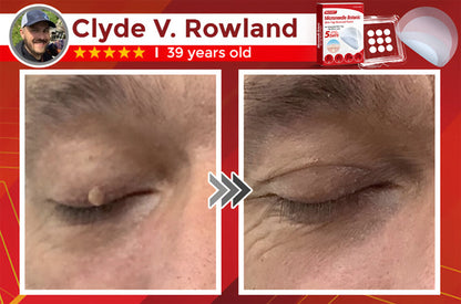 ✨Limited Time Discount🌿 Negusy™ MicroNeedle Skin Tag Remover Patch – Plant-Based & Painless