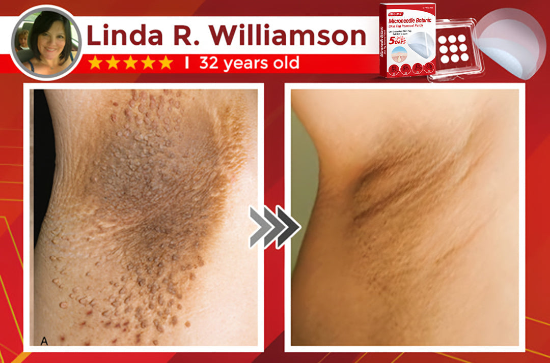 ✨Limited Time Discount🌿 Negusy™ MicroNeedle Skin Tag Remover Patch – Plant-Based & Painless