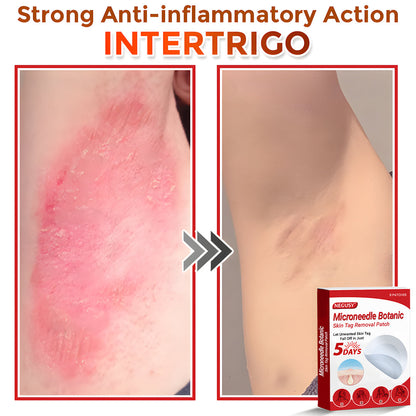 🔥Limited Time Discount🌿 Negusy™ MicroNeedle Skin Tag Remover Patch – Plant-Based & Painless