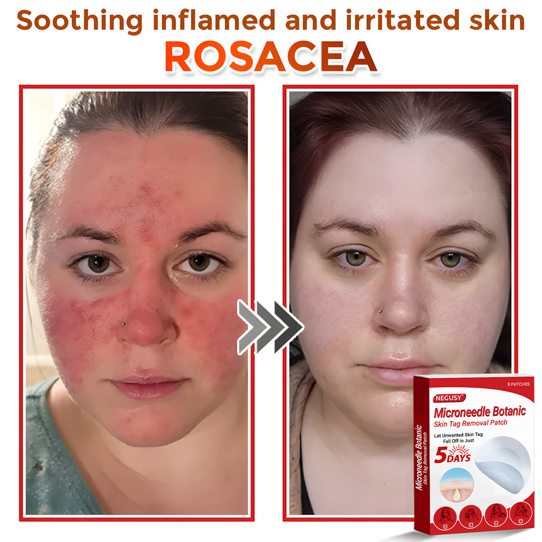 🔥Limited Time Discount🌿 Negusy™ MicroNeedle Skin Tag Remover Patch – Plant-Based & Painless