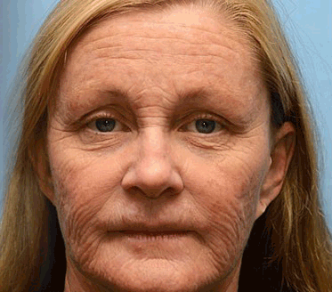 Negusy™ Botox-Infused Bee Venom Anti-Wrinkle Cream