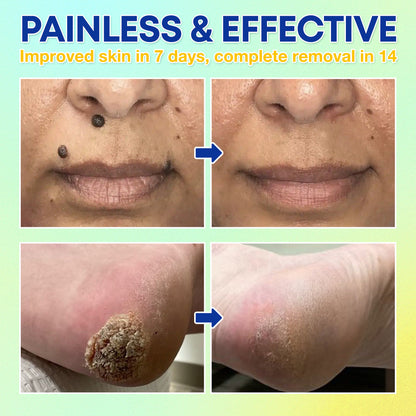 ❄️ LBMLBM™ Skin Tag Cryo Treatment Spray — Fast Freezing At-Home Removal ✨