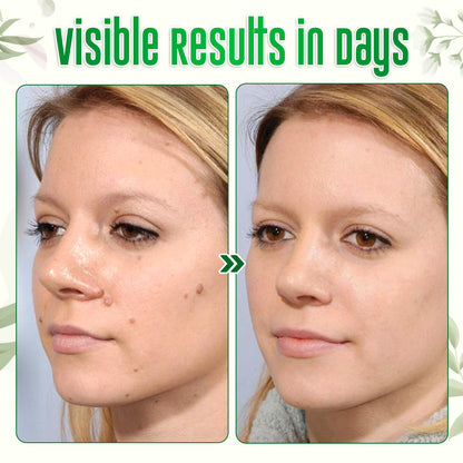 ✅Official Store: ODALIT™ Nature Erase Instant Mole & Spot Removal Gel