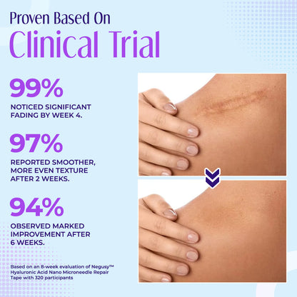 ✅Official Store |Negusy™ Hyaluronic Acid Nano Microneedle Repair Tape💷✴️(Treatment of old and new scars, reduction of surgical scars, stretch marks, keloids, acne, burns, warts, dermatomes and varicose veins)