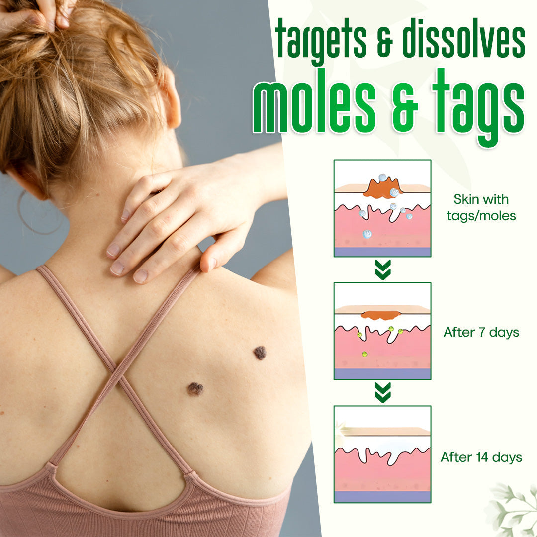 ✅Official Store: ODALIT™ Nature Erase Instant Mole & Spot Removal Gel