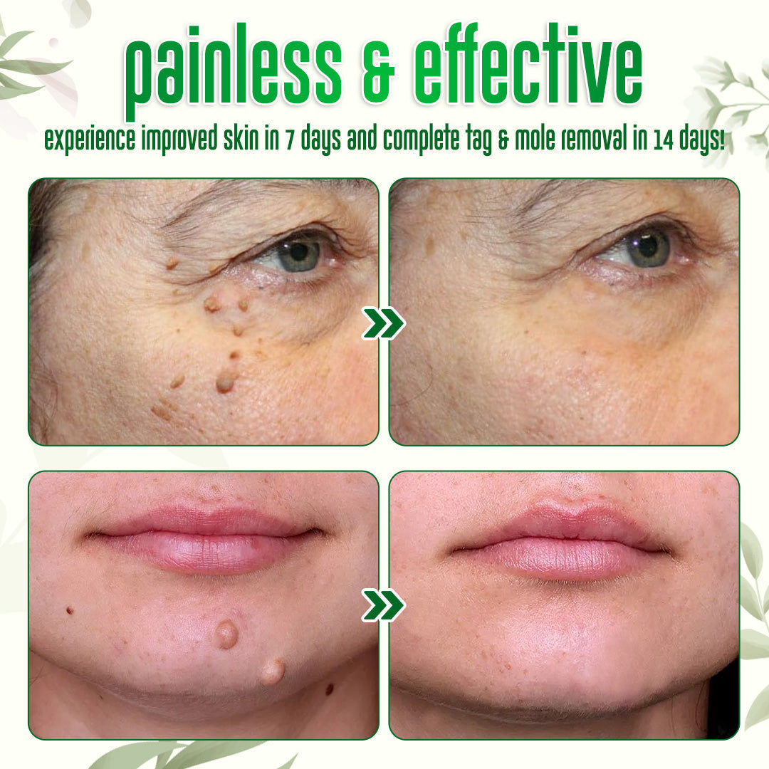 ✅Official Store: ODALIT™ Nature Erase Instant Mole & Spot Removal Gel