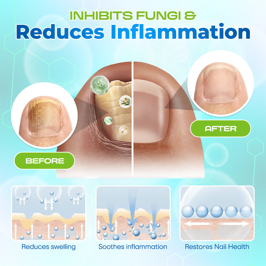 Lbmlbm® OnyxiGuard Fungal Repair Herbal Spray – 🌿 Natural Treatment for Healthy, Revitalized Skin & Nails ✨