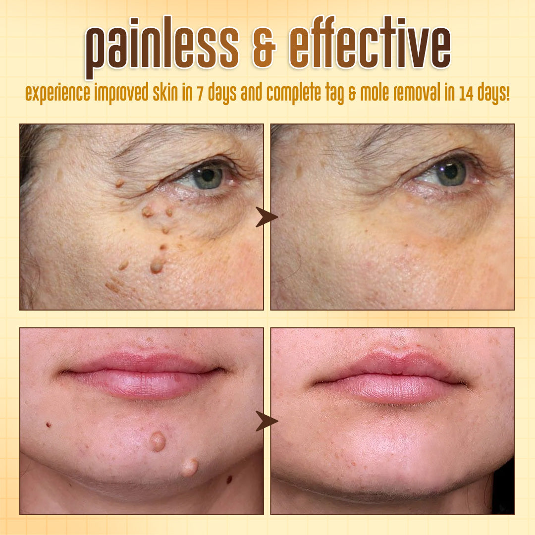 ✨ ODEIUN™ BeeDerm RX Cream – Natural Wart, Mole & Skin Tag Remover with Healing Bee Venom