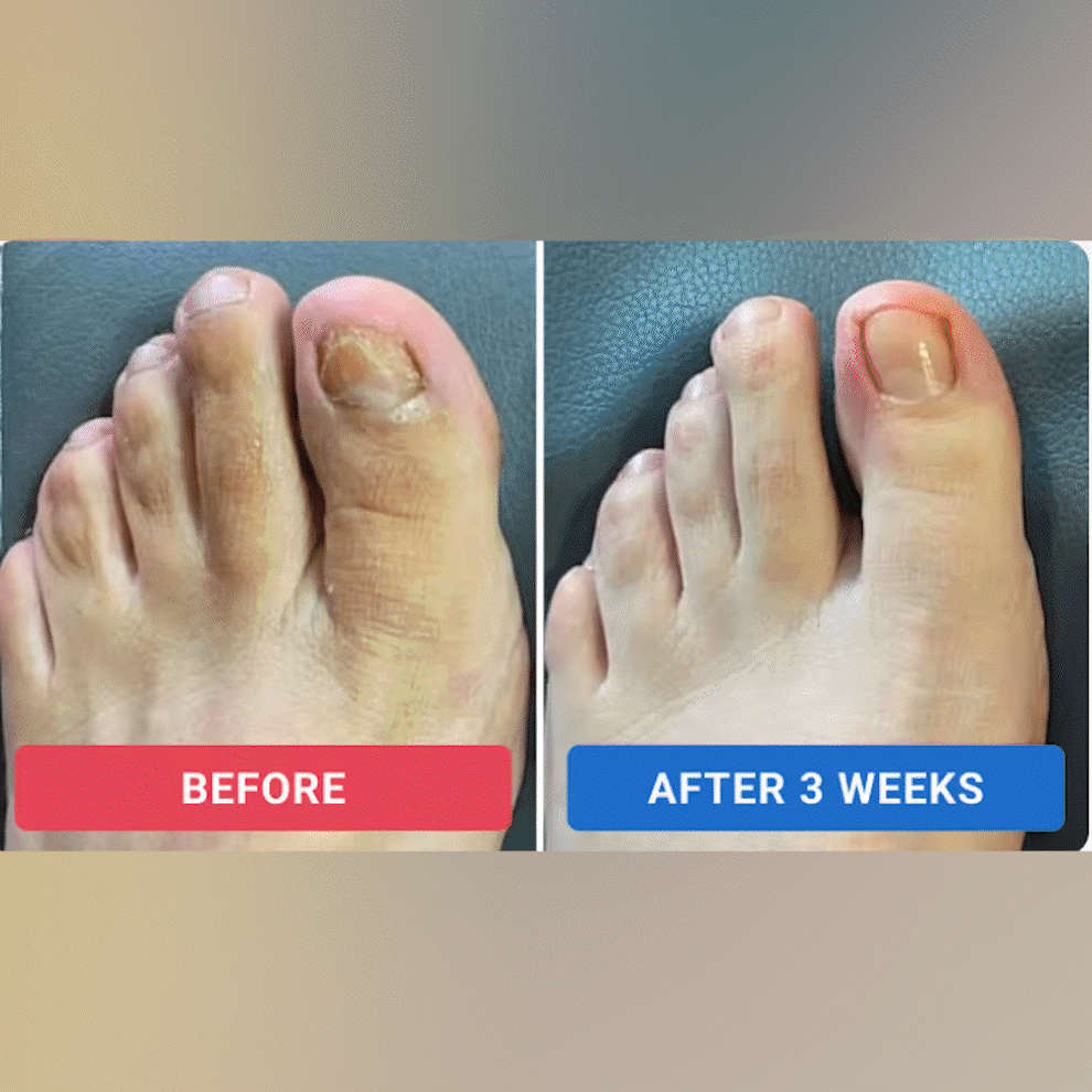 Odeiun™ - Fungal Nail Renewal Patches