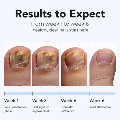 Odeiun™ - Fungal Nail Renewal Patches
