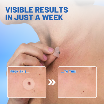 Jeremytis™ Moles & Warts Removing Skin Tag Patch