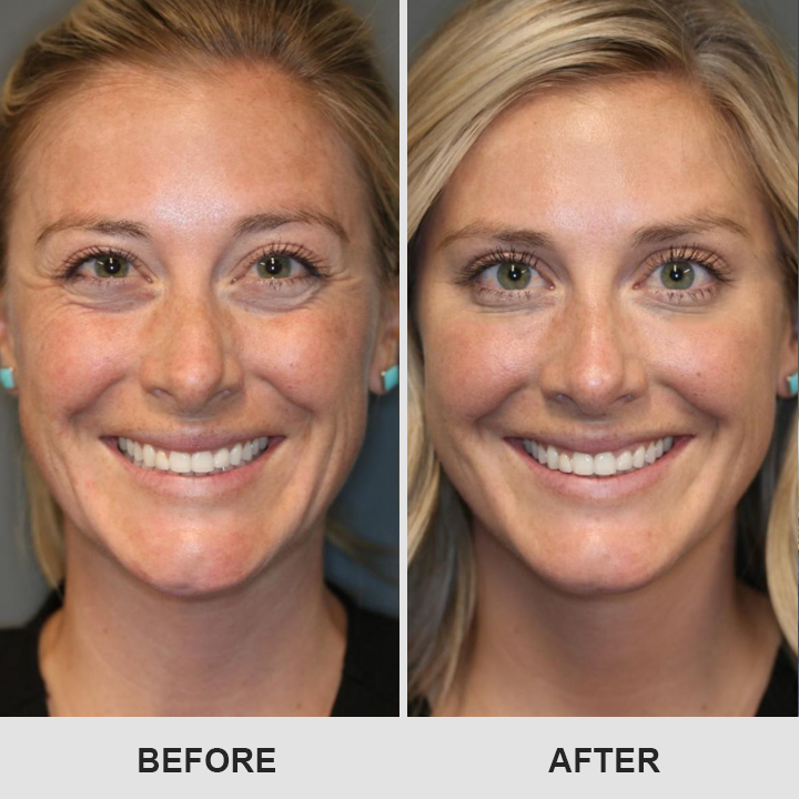 👁️ Seurico™ Retinol Eye Stick – Smooth Away Wrinkles, Puffiness & Dark Circles in Just Weeks!