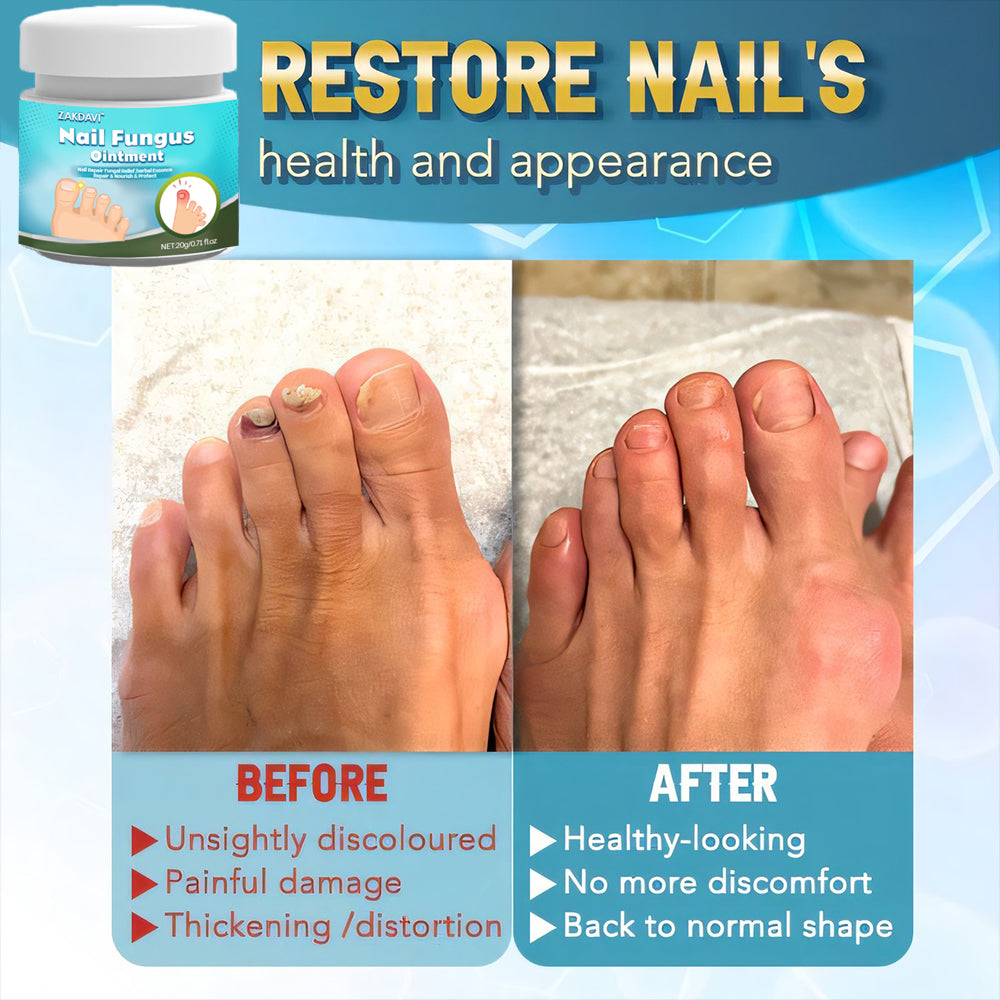 Zakdavi™ 5X Fast Healing Nail Fungus Ointment