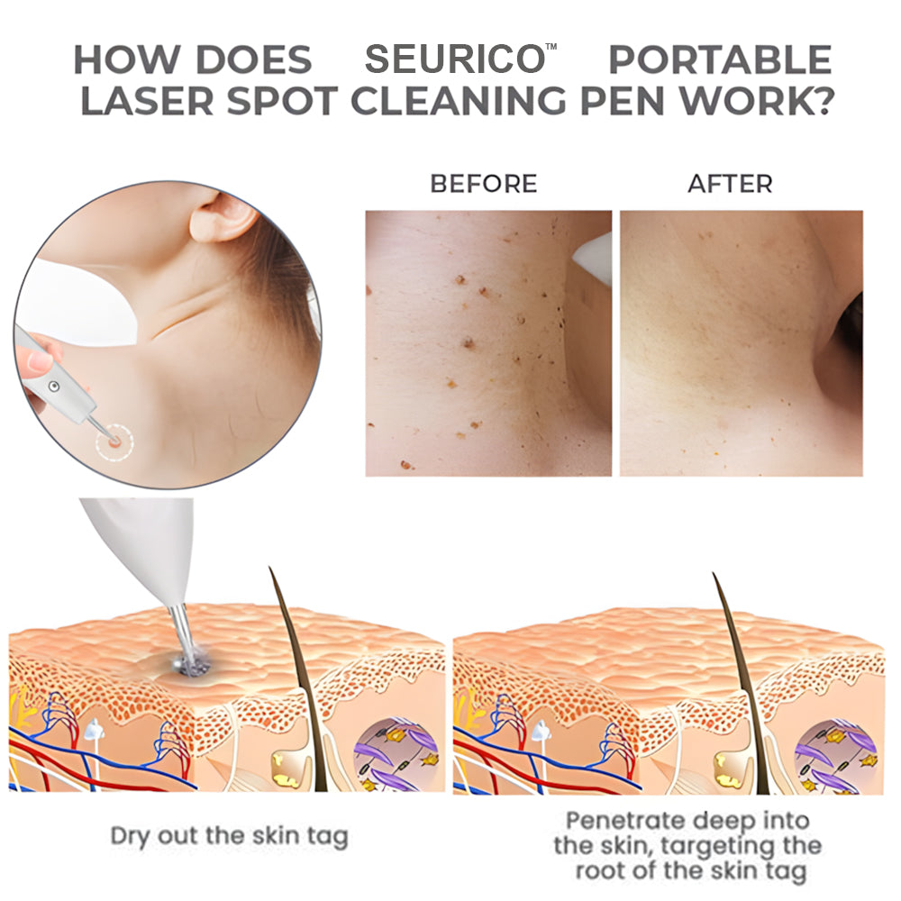 Seurico™ Portable Laser Spot Cleaning Pen