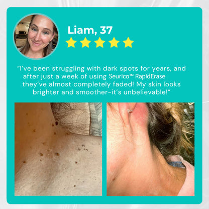 ✅ Official Store: Seurico™ Instant Mole & Spot Cream