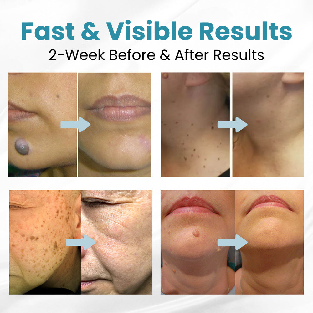 ✨Seurico™ Laser Pen - Non-invasive Mole and Wart Removal