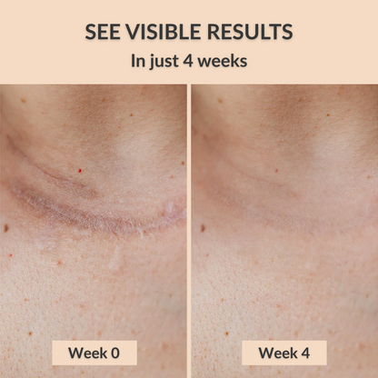 Negusy™ Silicone Scar Tape