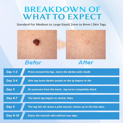 Seurico™ At-home Skin Tag Removal Pen