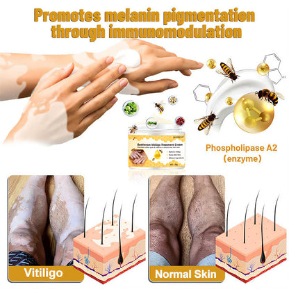 Seurico™ Bee Venom Treatment Cream for Vitiligo