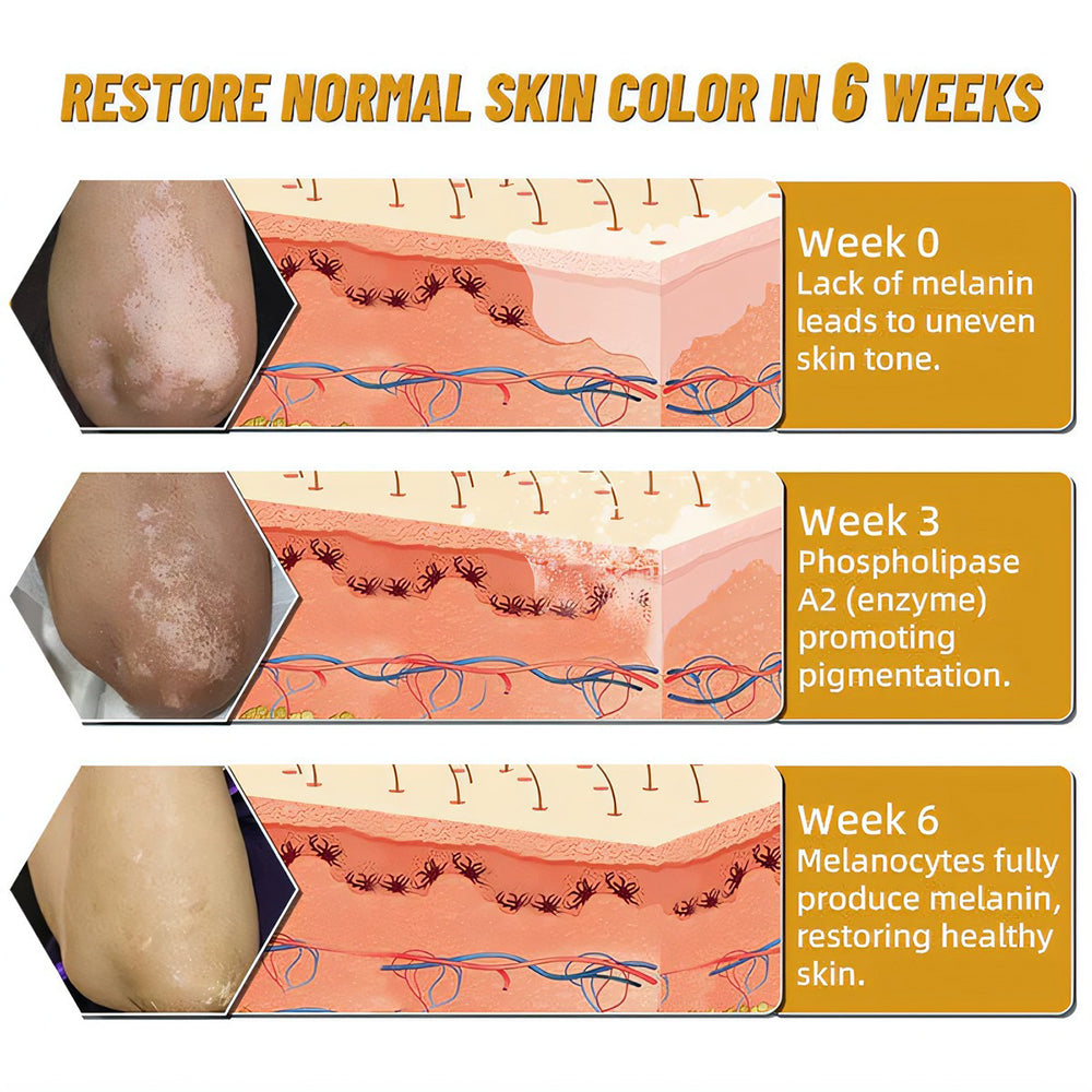 Seurico™ Bee Venom Treatment Cream for Vitiligo